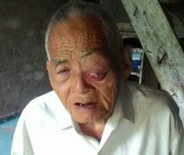 Mbah Turip yang terkena Tumor di mata kirinya